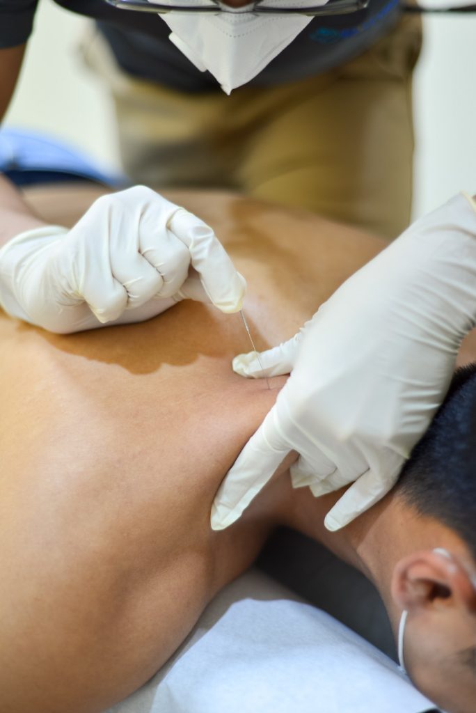 chiropractor performing dry needling on a patient